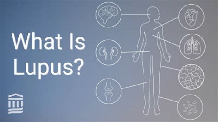 Does lupus cause you to sweat?