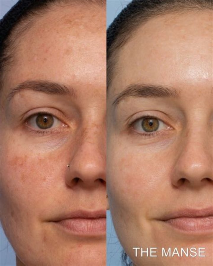 Does microdermabrasion remove hyperpigmentation?