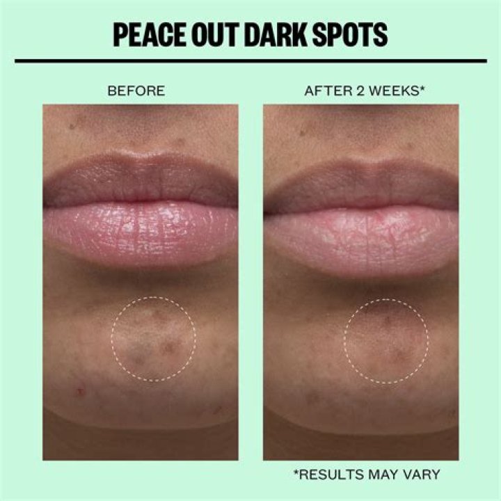Does microneedling fade dark spots?