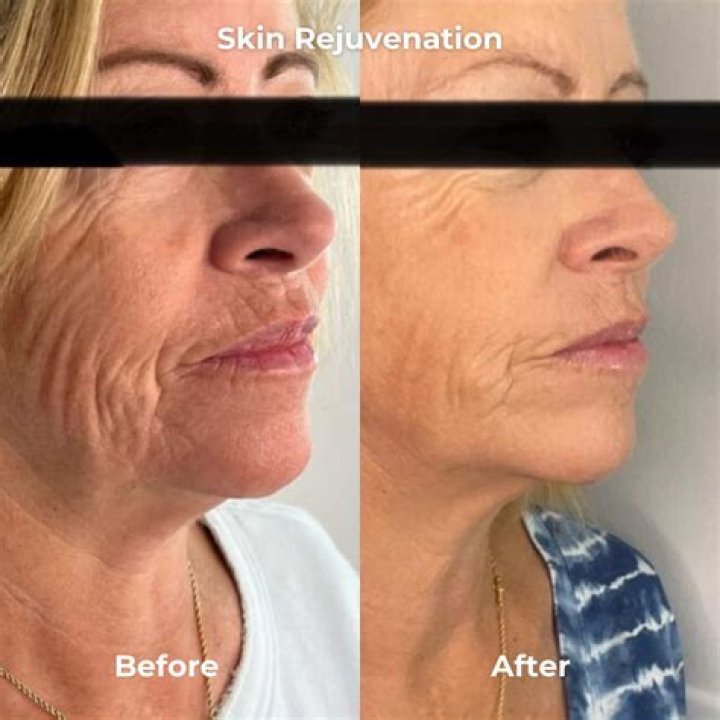 Does microneedling help deep wrinkles?