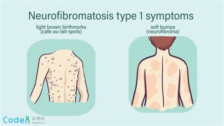 Does neurofibromatosis worsen with age?