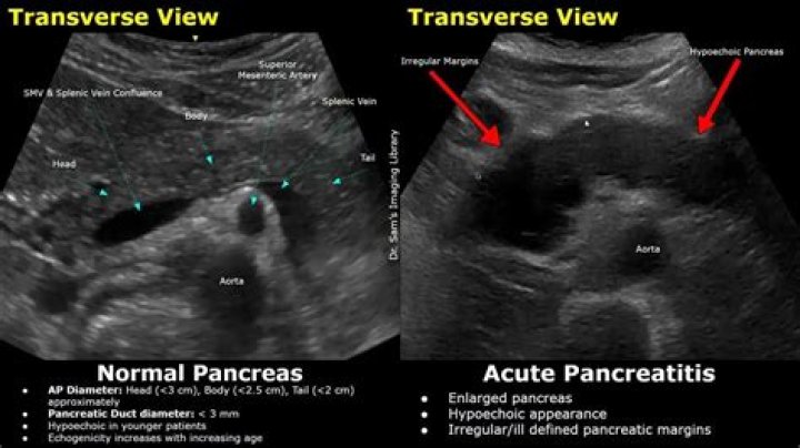 Does pancreatitis show up on ultrasound?