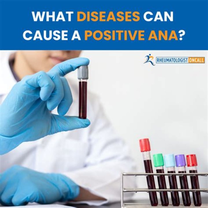 Does PANDAS cause a positive ANA?