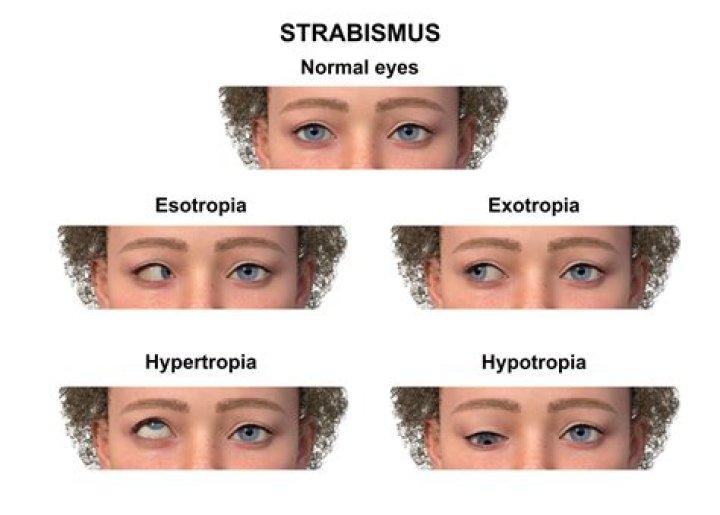 Does patching fix strabismus?