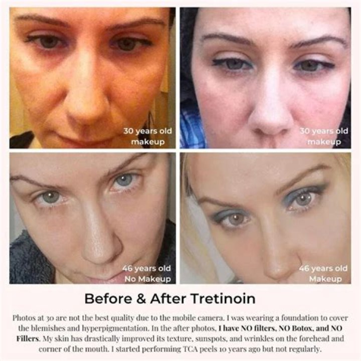 Does tretinoin work for under eye wrinkles?