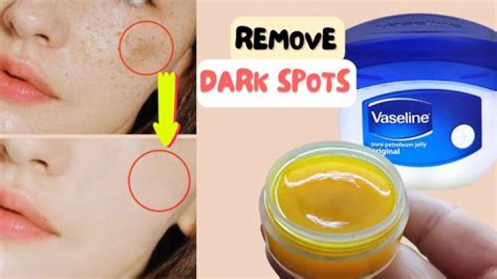 Does Vaseline help hyperpigmentation?