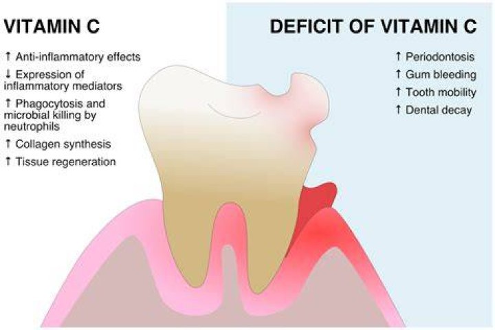 Does vitamin D deficiency affect gums?