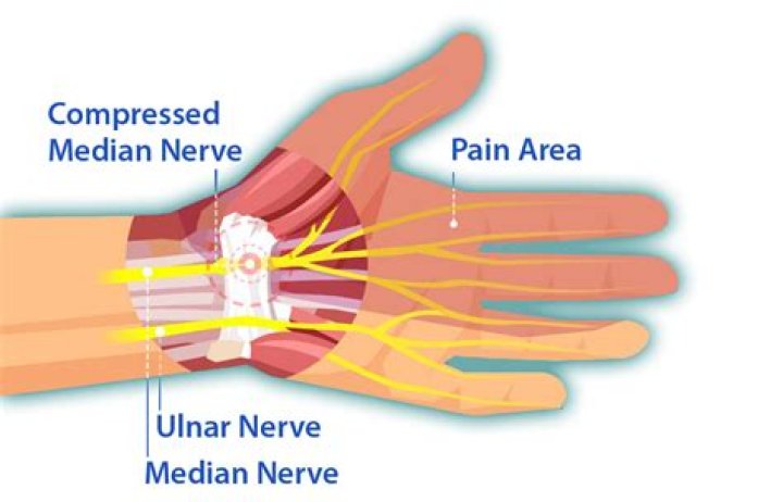 Does Voltaren Gel help carpal tunnel?