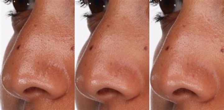 How can I get rid of sebum in my nose naturally?