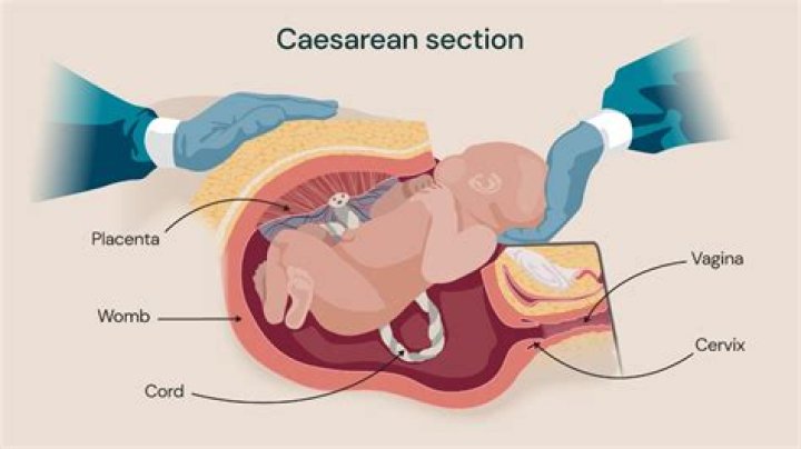 How can I make my C-section shelf go away?