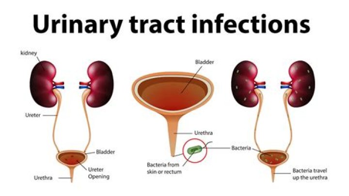 How can I prevent UTI naturally?