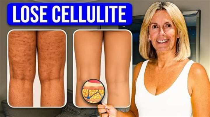 How can I reduce cellulite on my legs?