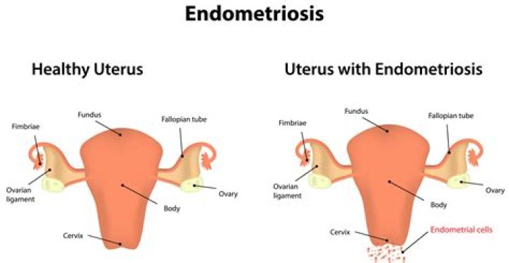 How can you prevent endometritis?