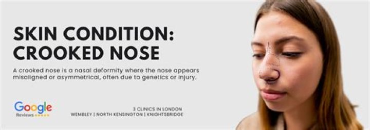 How common is a crooked nose?