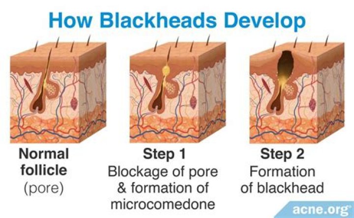 How do 11 year olds get rid of blackheads?