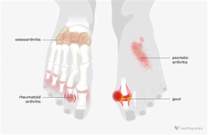 How do I know if I've got arthritis in my toes?