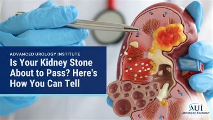 How do I know if I've passed a kidney stone?