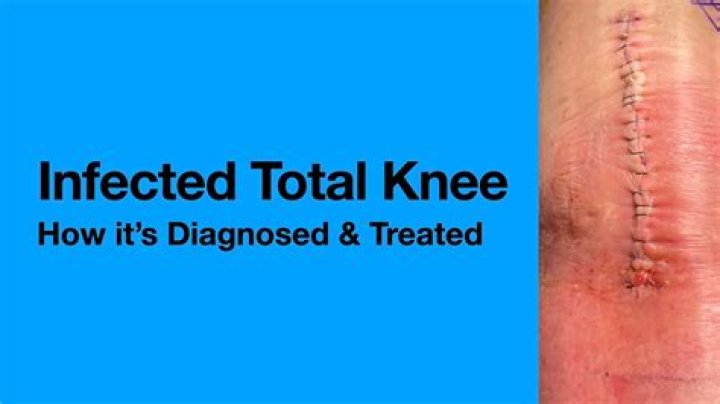 How do I know if I have an infected joint?