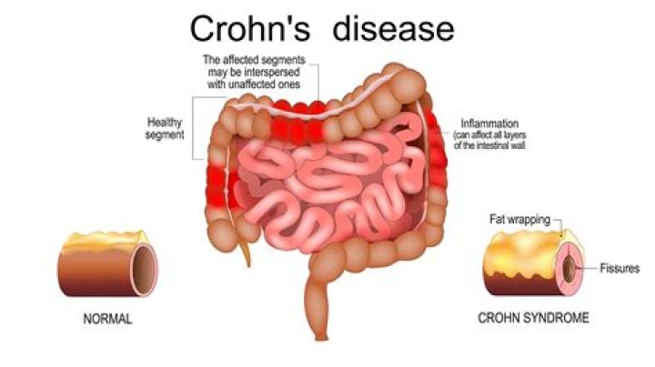 How do I know if I have IBS or Crohn's?