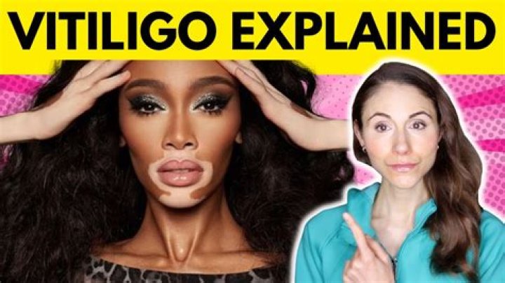 How do I know if I have vitiligo at home?