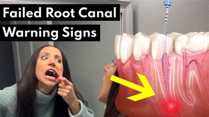 How do I know if my root canal failed?