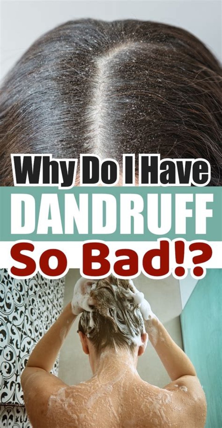 How do I stop picking my dandruff?