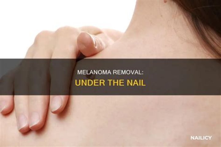 How do they remove a melanoma?