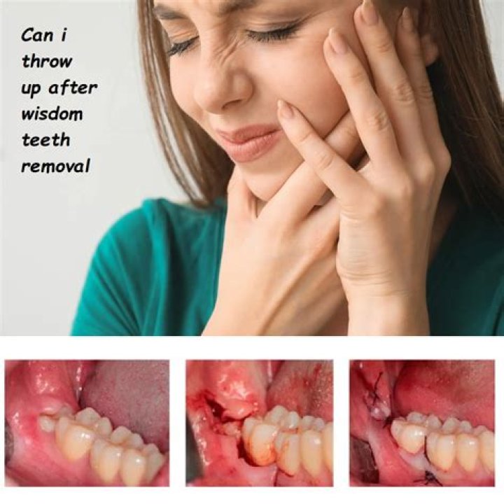 How do you clean wisdom teeth holes?