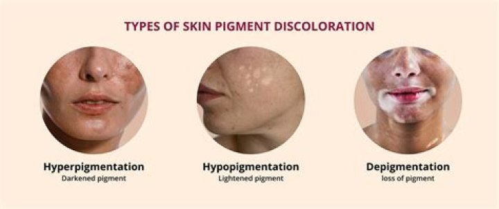 How do you color correct hypopigmentation?