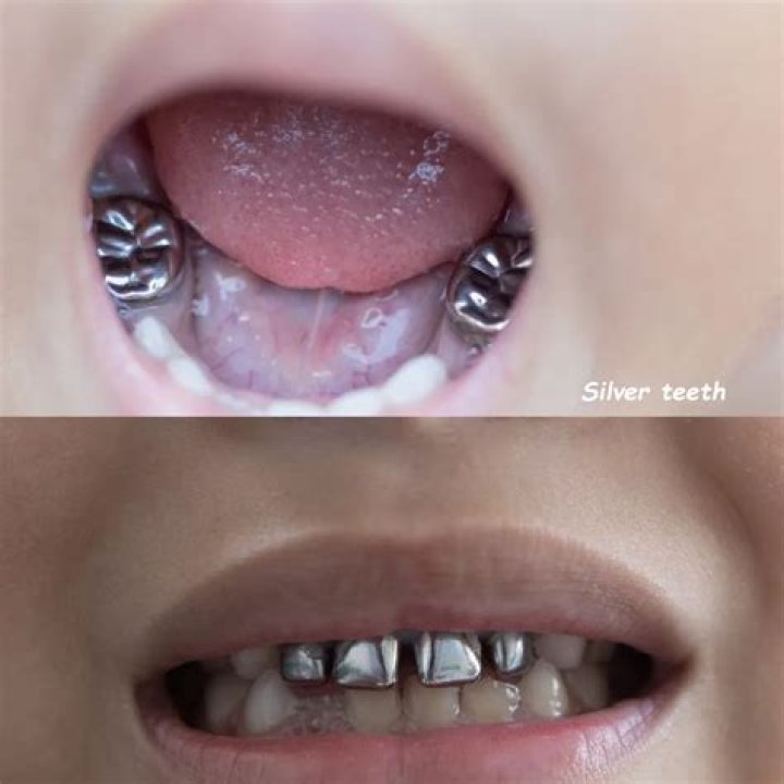 How do you cover silver teeth?