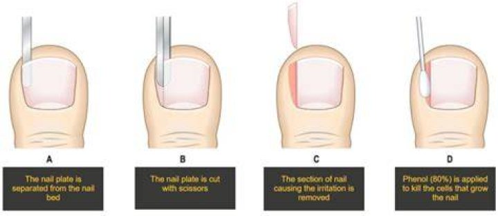 How do you cut an ingrown toenail painlessly?