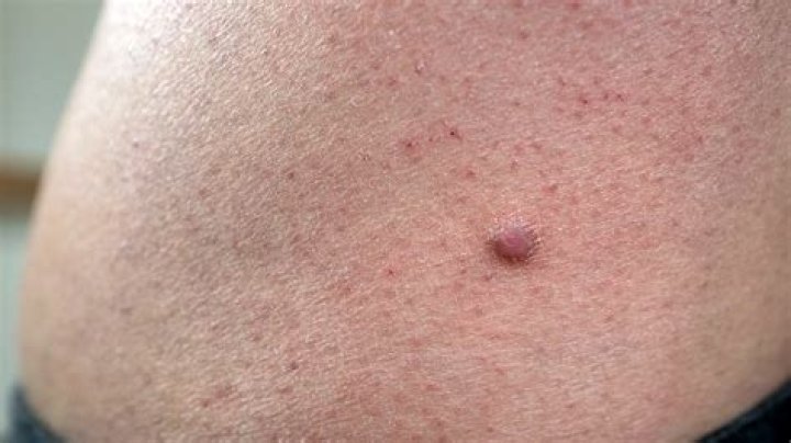 How do you describe a dermatofibroma?