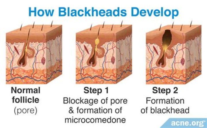 How do you exfoliate blackheads?