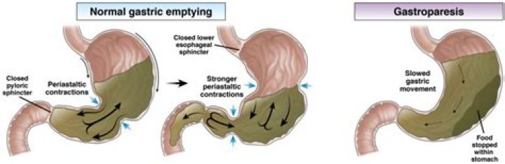 How do you fix gastroparesis?