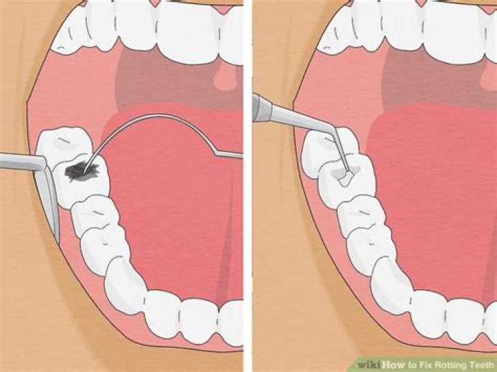 How do you fix rotting teeth?