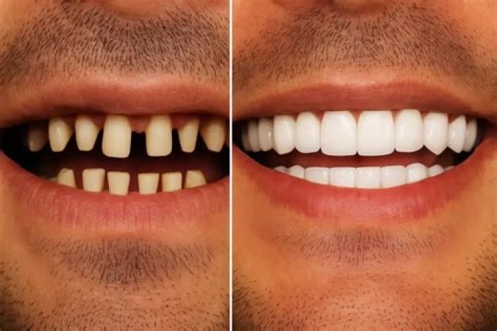 How do you get good teeth without veneers?