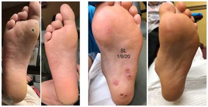 How do you get rid of HPV warts on your feet?