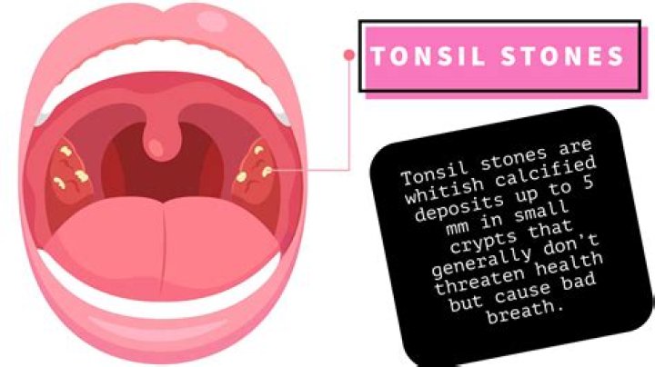 How do you get rid of tonsil stones without touching them?