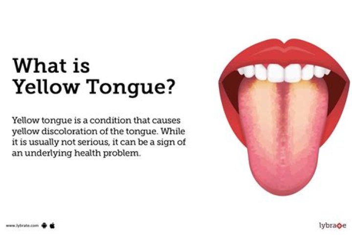 How do you get rid of yellow tongue?