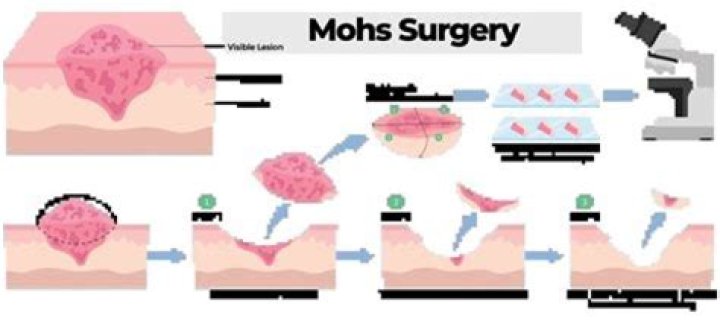 How do you know if you need Mohs surgery?