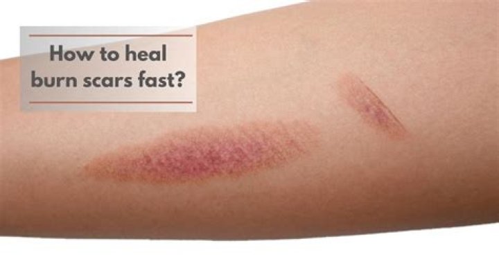 How do you reduce the redness of a burn scar?