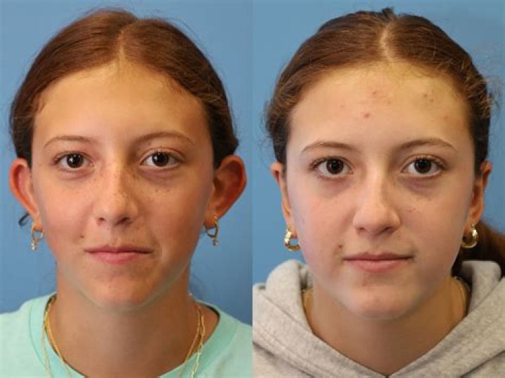 How do you shower after otoplasty?