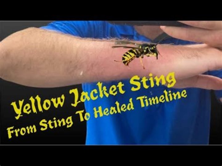 How do you stop a yellow jacket sting from hurting?