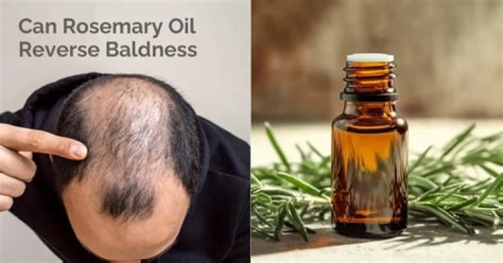 How do you use rosemary oil for baldness?
