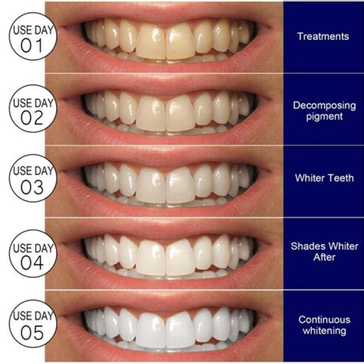 How do you whiten fake teeth?