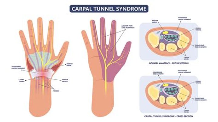 How does EMG diagnose carpal tunnel?