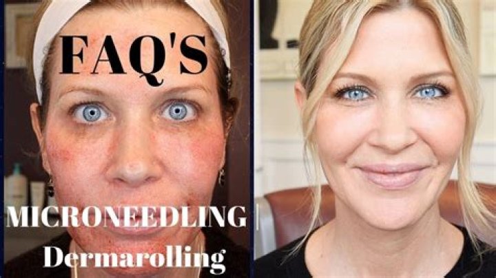 How does face look after microneedling?