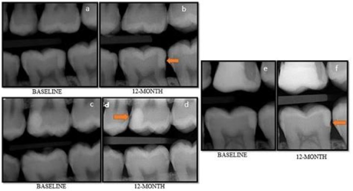 How does GIC bond to tooth?