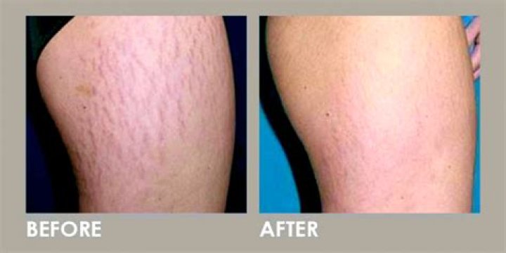 How does laser remove stretch marks?