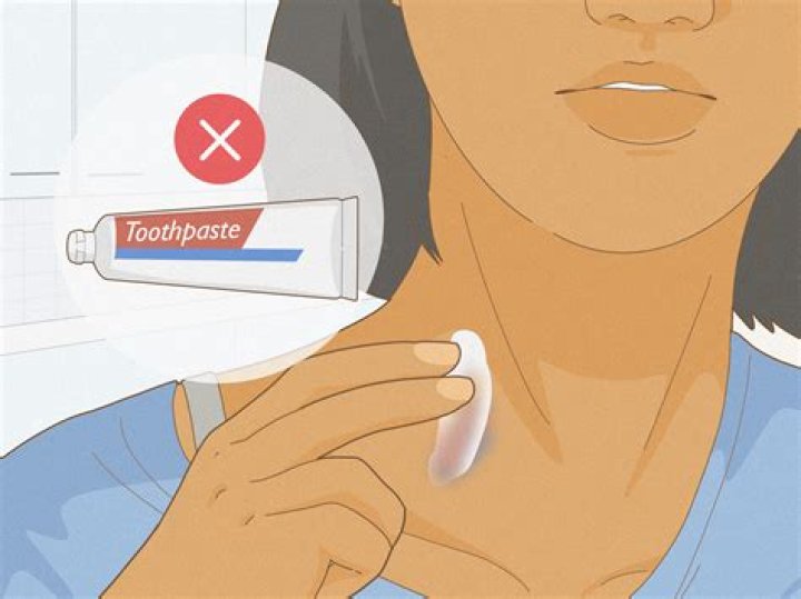 How does toothpaste get rid of hickeys on seconds?